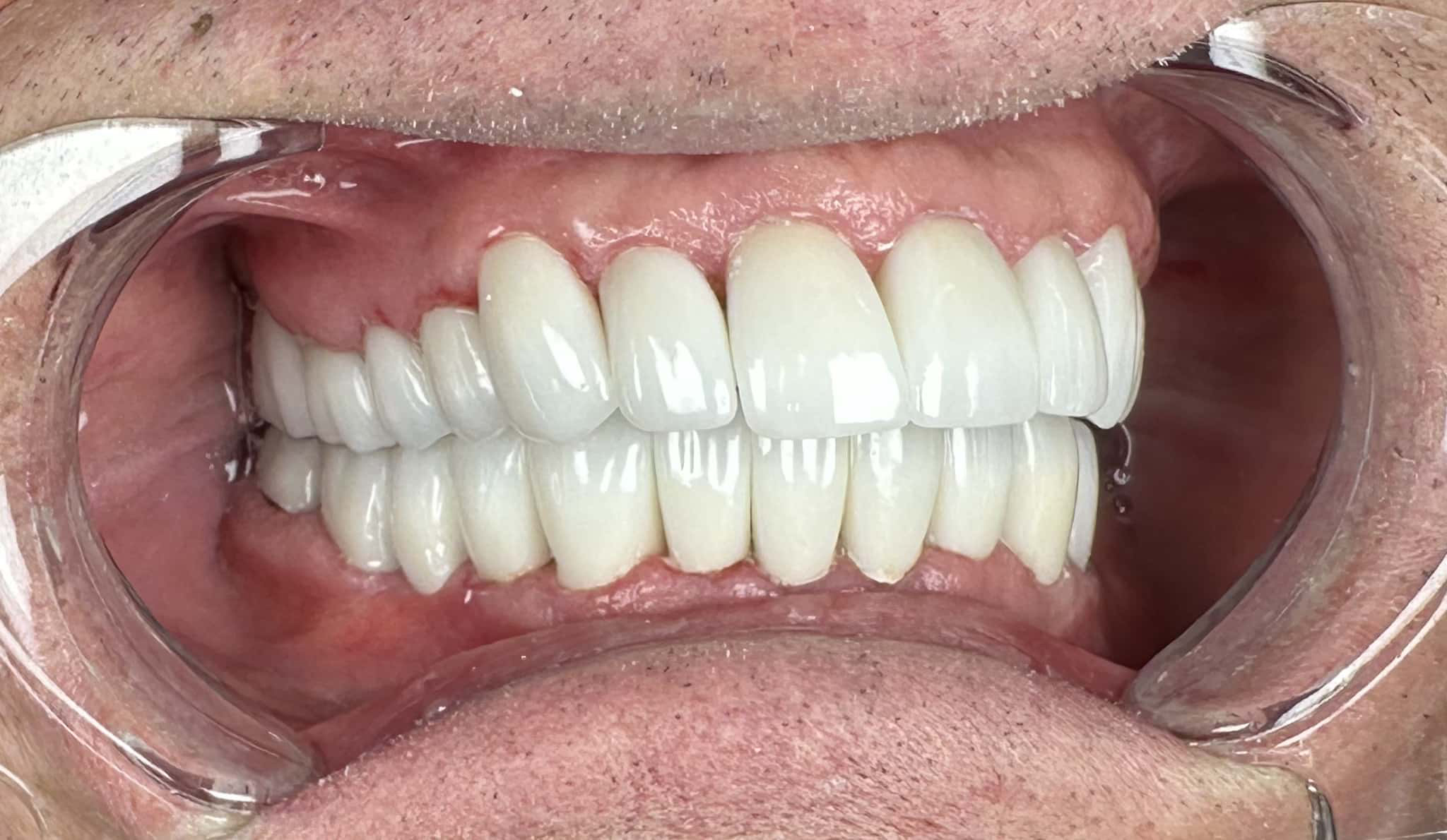 circle-dental-implants-patient-testimonial-full-mouth-restoration-after