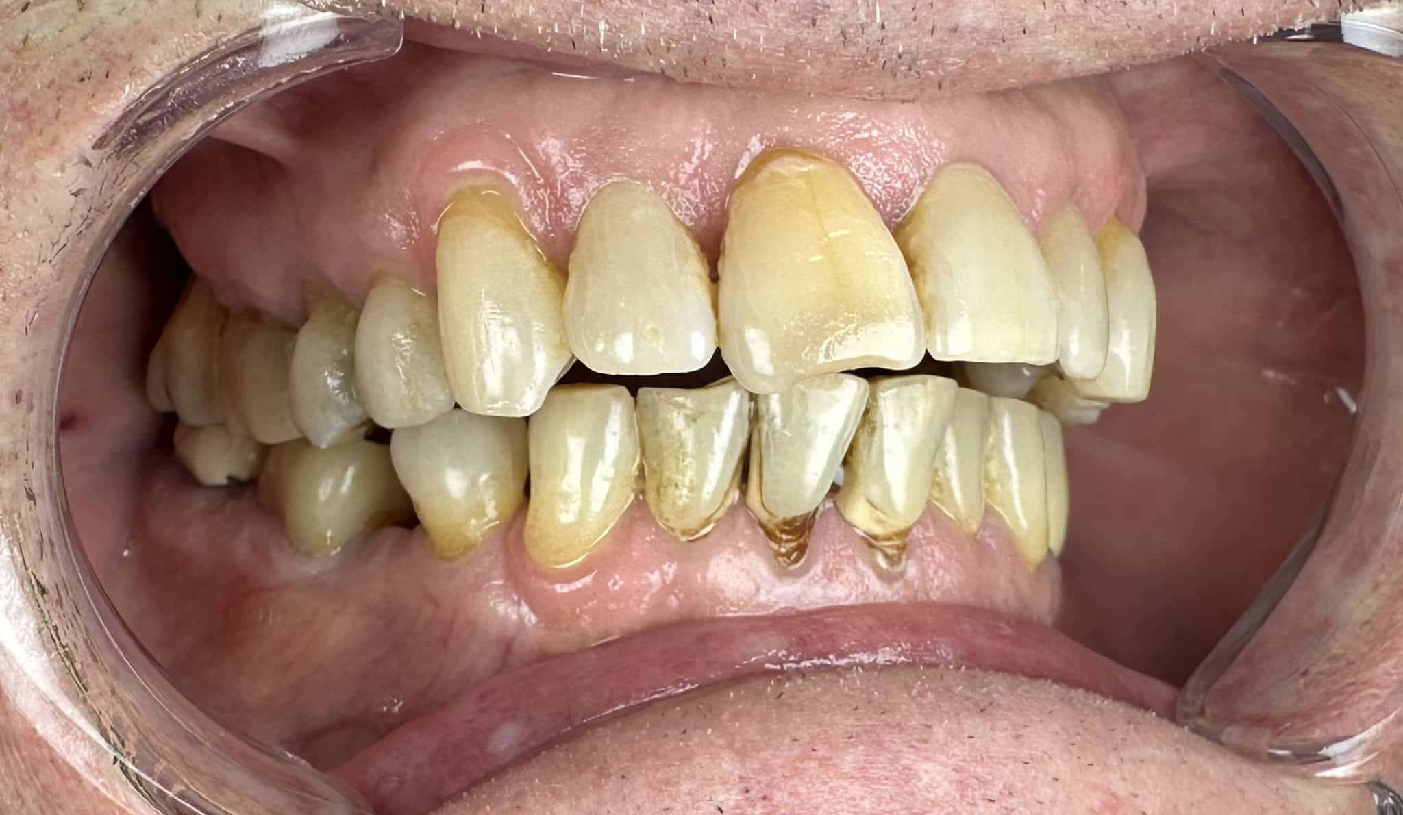 circle-dental-implants-patient-testimonial-full-mouth-restoration-before
