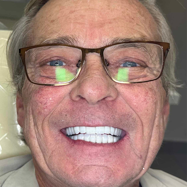 circle-dental-implants-patient-testimonial-full-mouth-restoration